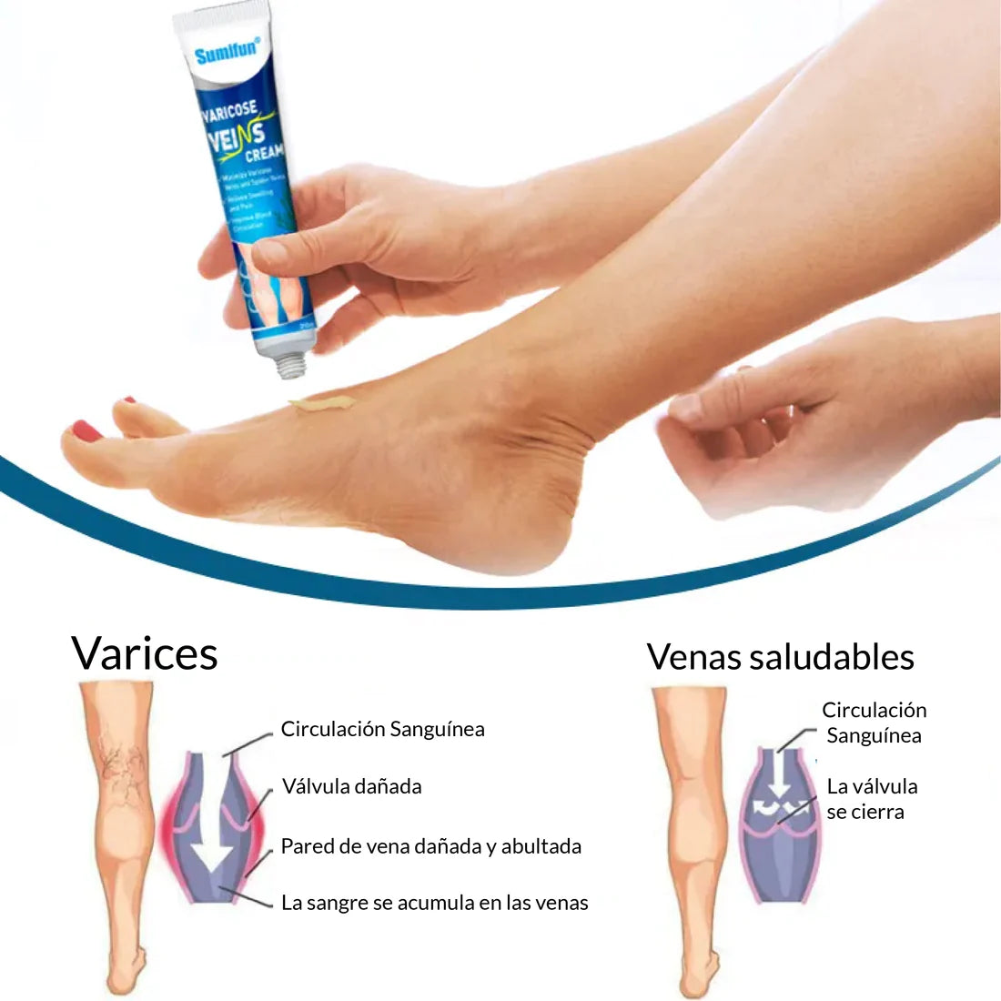 Crema de Venas Varicosas™- Tratamiento para combatir las varices